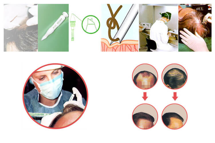 Collage di immagini di persone con problemi di capelli e medici Medicenter che risolvono il problema
